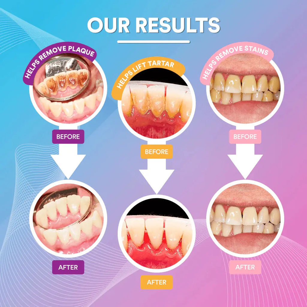 Ultrasonic Tooth Cleaner *BEST SELLER* Soya Confort
